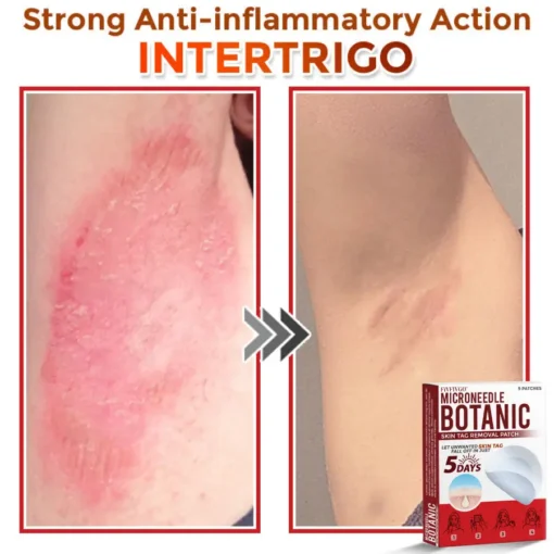 Fivfivgo® MicroNeedle Botanic Skin Tag Removal Patch