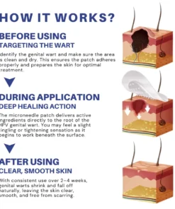 Fivfivgo® Microneedle HPV Genital Warts Removal Patch