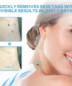 Fivfivgo® Painless At-home Skin Tag Removal Pen
