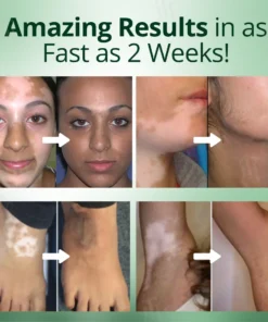 Fivfivgo® Vitiligo Treatment Cream