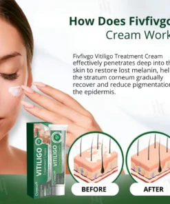 Fivfivgo® Vitiligo Treatment Cream