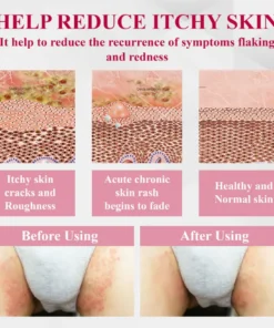 Fivfivgo® Woman's Genital HPV Healing Cream