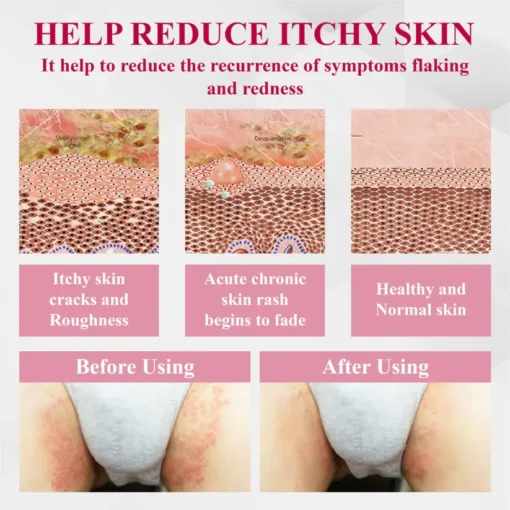 Fivfivgo® Woman's Genital HPV Healing Cream