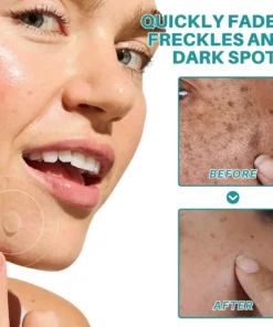 Fivfivgo® Botanical Freckles & Spot Removal Patch