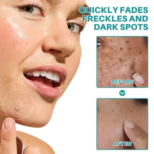 Fivfivgo® Botanical Freckles & Spot Removal Patch