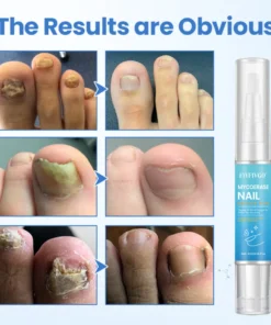 Fivfivgo® MycoErase Nail Revive Pen