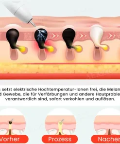 Fivfivgo™ Tragbarer Hautpflege-Laserstift