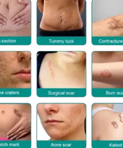 Fivfivgo™ Advanced Scar Removal Spray