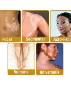 VitiGO™ Bee Venom Corrector Cream