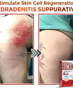 Fivfivgo® MicroNeedle Botanic Skin Tag Removal Patch Made in the USA