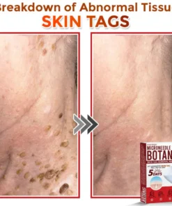Fivfivgo® MicroNeedle Botanic Skin Tag Removal Patch Made in the USA