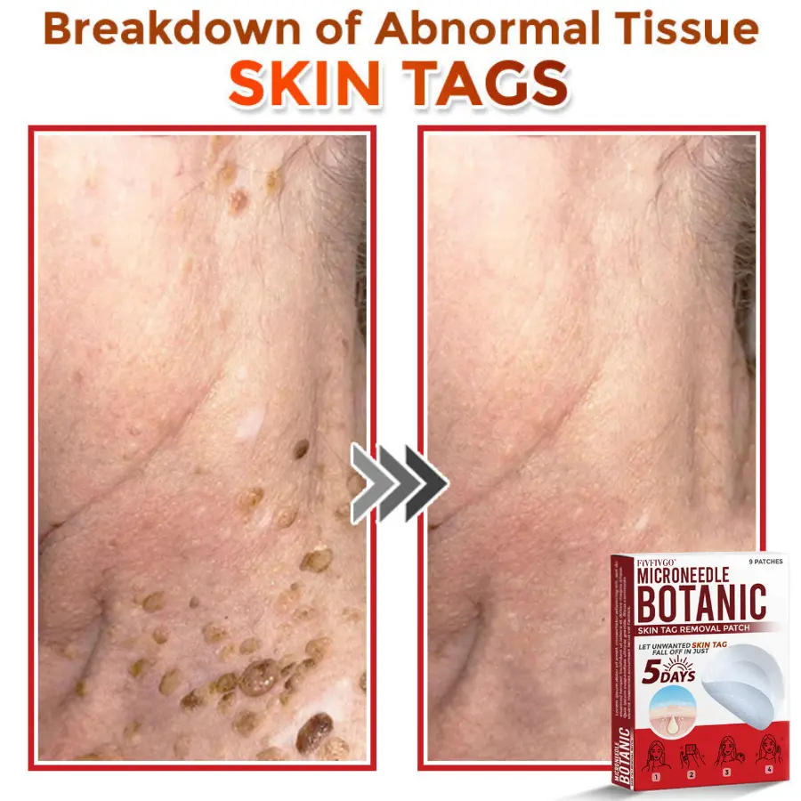 Fivfivgo® MicroNeedle Botanic Skin Tag Removal Patch Made in the USA