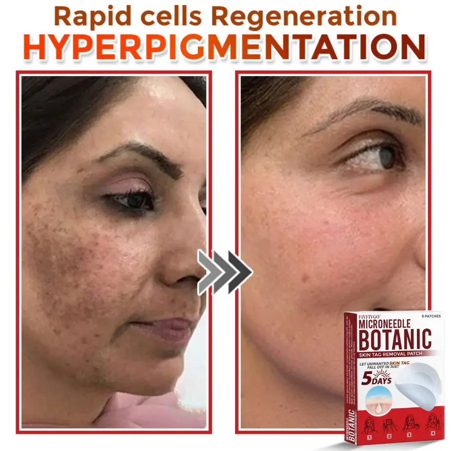 Fivfivgo® MicroNeedle Botanic Skin Tag Removal Patch Made in the USA